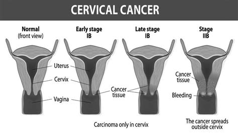 How Many Women Die From Cervical Cancer Cancerwalls