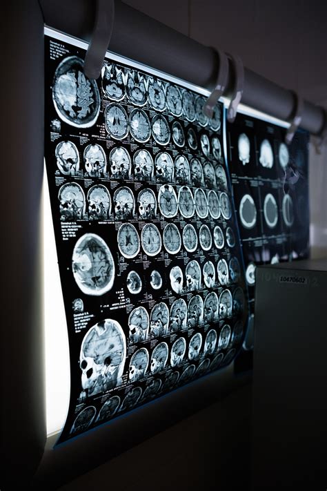 MRI מח - המדריך המלא - בריאות