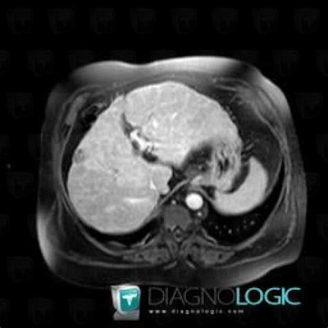 Radiology case : Hemangioma (US ,MRI) - Diagnologic