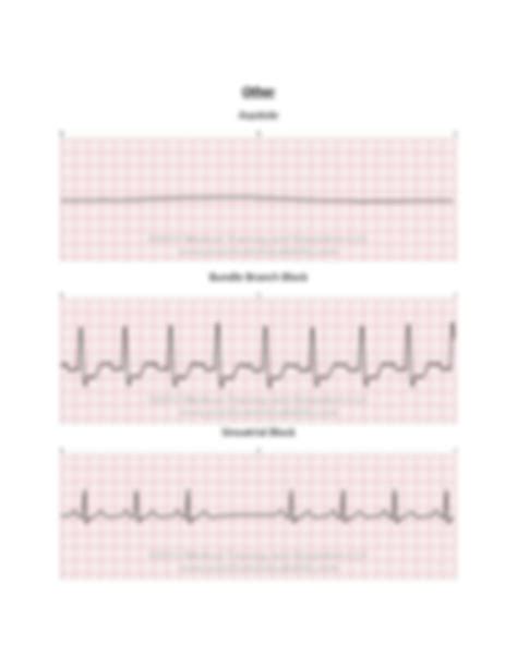 Solution Ekg Strips Docx Studypool