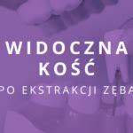 Kiedy zakłada się szwy po wyrwaniu zęba Ekstrakcja z szyciem DentInfo