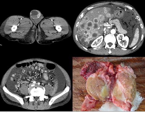 Figure From Adenocarcinoma Of Rete Testis With Widespread Liver