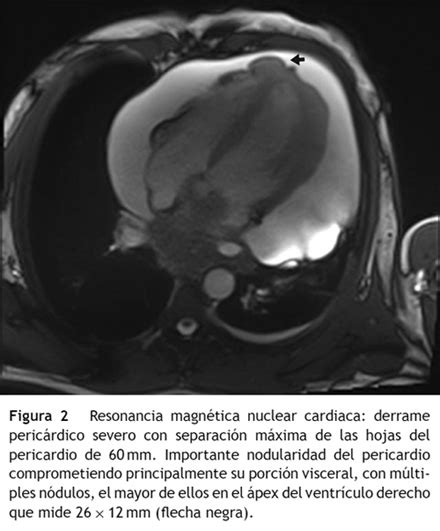 Mesotelioma pericárdico primario manifestado como derrame pericárdico