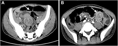 Frontiers 3d Laparoscopy Assisted Operation To Adult Intussusceptions