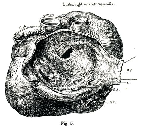 27 Atrial Septal Defect Maude Abbott Medical Museum Mcgill University