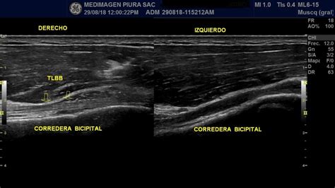 Desgarro tendón largo bíceps braquial Ecografía Deportiva