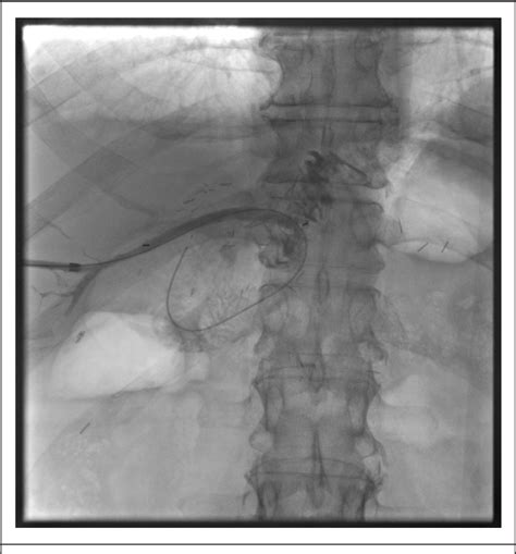 Figure From The Novel Use Of A Biodegradable Stent Placed By