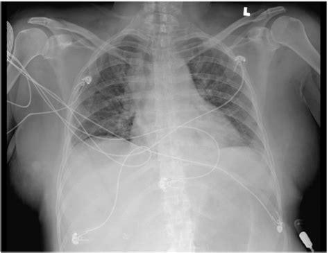 Portable Anterior Posterior Chest Radiograph Demonstrating Borderline