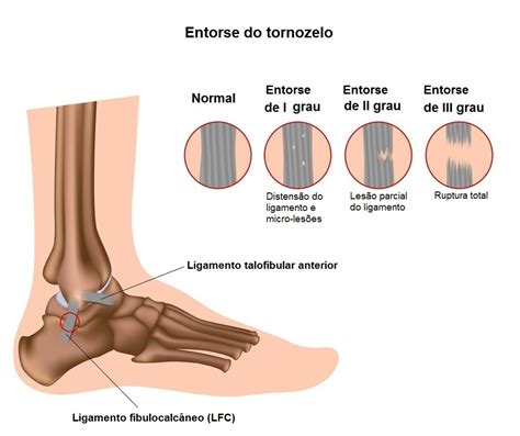 Dor No Tornozelo O Que Pode Ser - Artrite Reumatoide Pes E Tornozelos Dor No Pé: Veja As Causas Da Dor