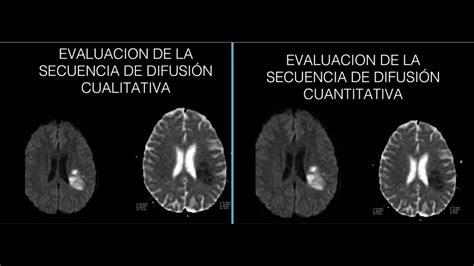 Secuencia de Difusión DWI cerebral Parte 1 Principios básicos Dr