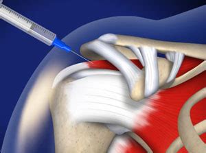 Subacromial Impingement Injection