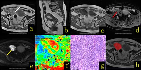 Frontiers The Value Of Mri Findings Combined With Texture Analysis In The Differential