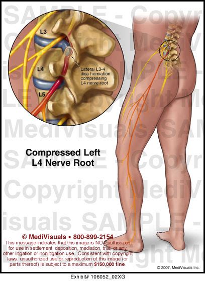 Compressed Left L4 Nerve Root Medical Illustration Medivisuals