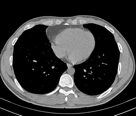 Radiopaedia Case Morgagni Hernia Id 16429 Study 16116 NC Commons