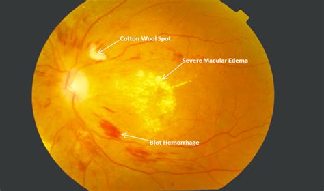 Severe Nonproliferative Diabetic Retinopathy