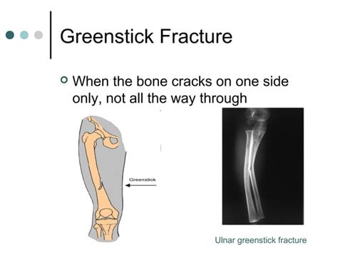 Fractures Sprains And Dislocations Ppt