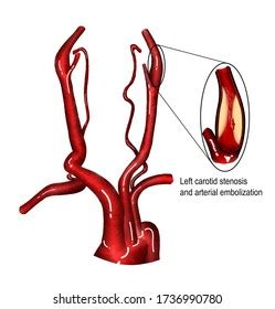 carotid artery stenosis images stock  vectors shutterstock