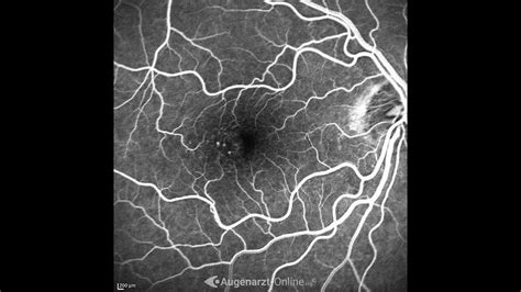 Teleangiektasien Atlas Der Augenheilkunde