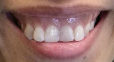 Cosmetic Bonding Brookline Village Dental Dr Peter Juriansz