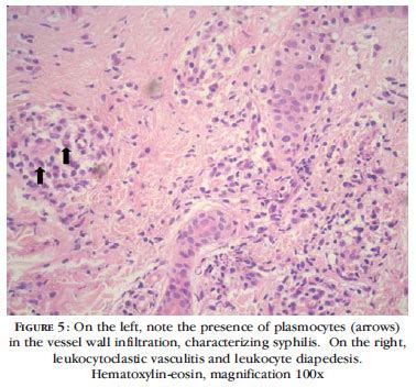 Primary Syphilis Histology