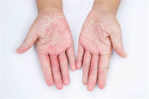 Dry Skin On Feet Causes Symptoms Home Remedies And Treatment Pictures