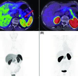 A Ga Dotatate Pet Ct Mild Focal Uptake In Pancreatic Tail