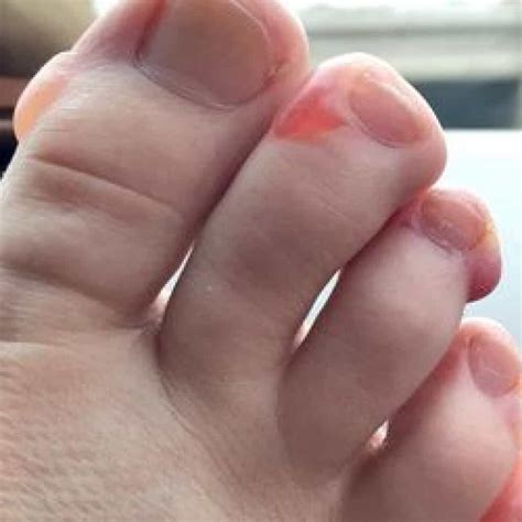 Blister On Foot That Won T Heal Online Emergencydentistry