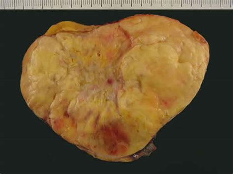 Fig 4 Aspecto Macroscópico De Un Liposarcoma Bien Diferenciado Tipo