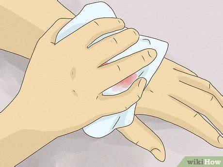 Ways To Heal Cuts Quickly Using Easy Natural Items Wikihow