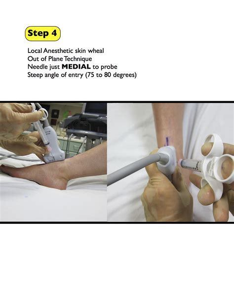 Arthrocentesis: Ankle — Highland EM Ultrasound Fueled pain management