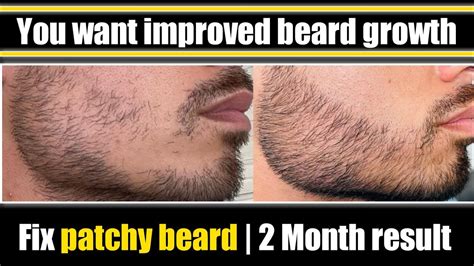 How To Grow Beard Faster Fix Patchy Beard In 2 Month You Want