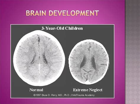 Early Childhood Trauma and Brain Development