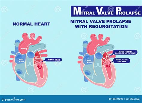 The Mitral Valve Stock Illustration | CartoonDealer.com #157581691