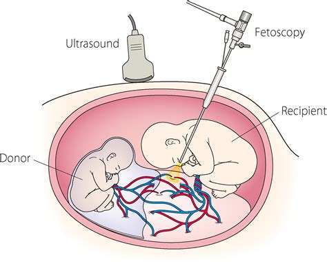 Fetoscopic Laser Photocoagulation For Twintwin Transfusion Syndrome