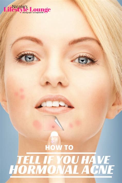 How To Tell You Have Hormonal Acne — Nicoles Lifestyle Lounge Chin