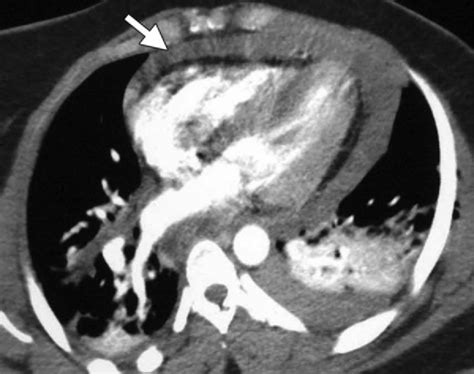 Acute hemopericardium in a 35-year-old woman involved in a motor ...