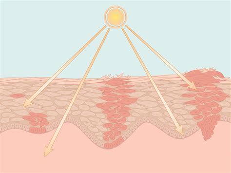 Pdt Photodynamische Therapie Bei Atos Dermatologie