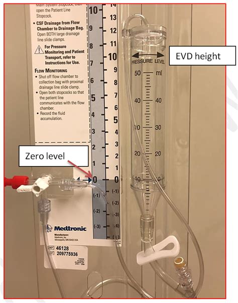 External Ventricular Drain