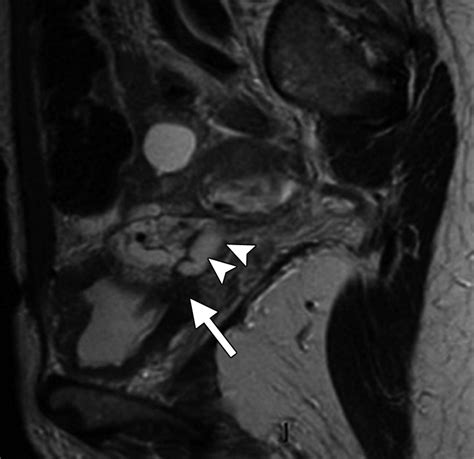 Mr Imaging In Deep Pelvic Endometriosis A Pictorial Essay Radiographics