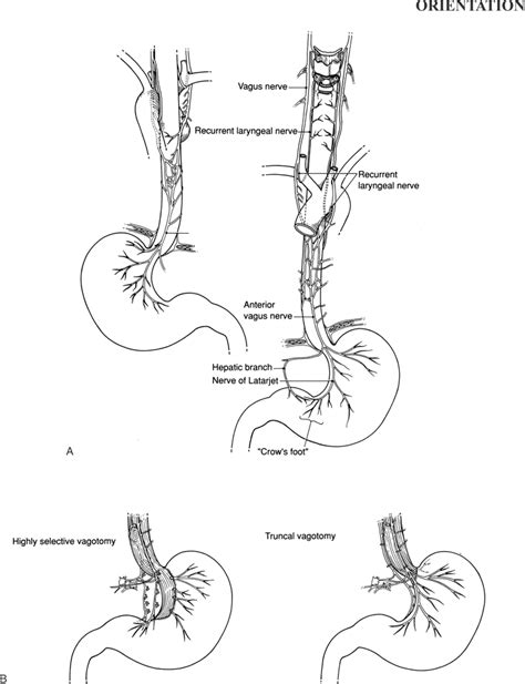 Truncal Vagotomy and Pyloroplasty and Highly Selective Vagotomy ...