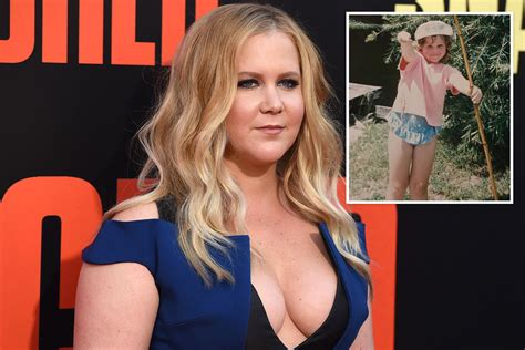 Amy Schumer Reveals Lyme Disease Diagnosis And Says She May Have Had