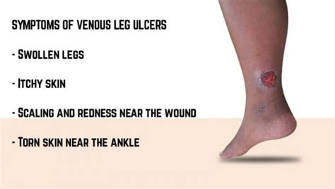 Venous Leg Ulcer: Symptoms, Causes, and Prevention