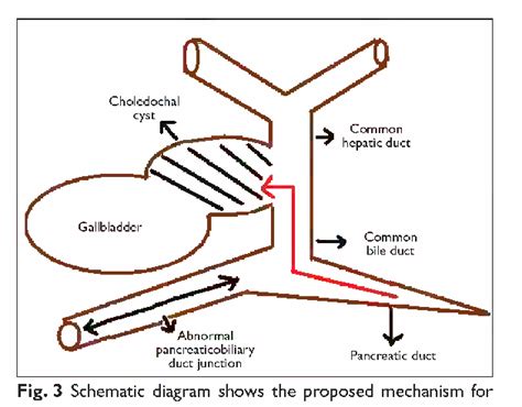 Figure 2 From Type Vi Choledochal Cyst Revisited Semantic Scholar