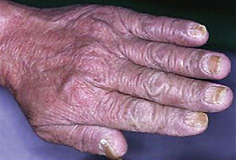 Figure From A Review Of Nail Changes In Acrokeratosis Paraneoplastica