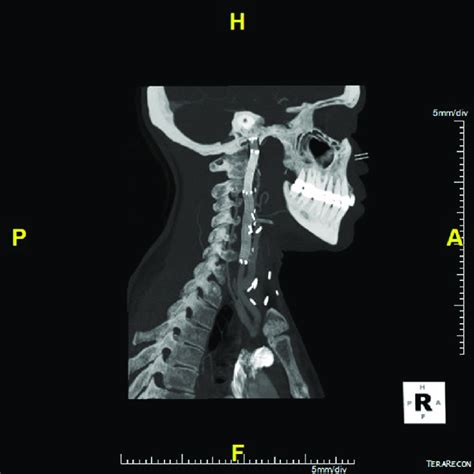 Six Month Computed Tomography Angiogram Confirming Correct Exclusion Of