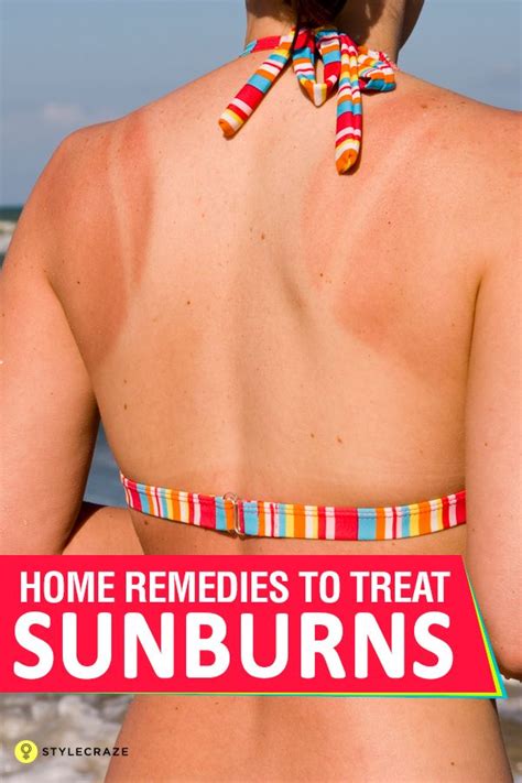 Sunscreen Tips And Tricks Sunburn Remedies Natural Remedies For Sunburn How To Treat Sunburn