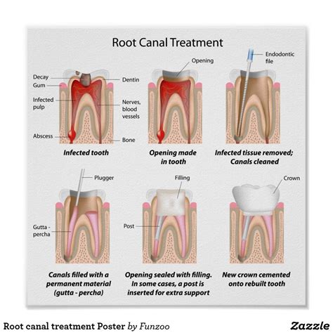 After Root Canal Treatment Swelling