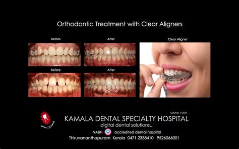 Orthodontic Treatment With Clear Aligners Kamala Dental