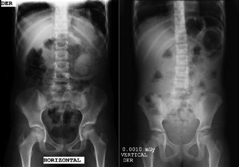 Radiografia De Abdomen