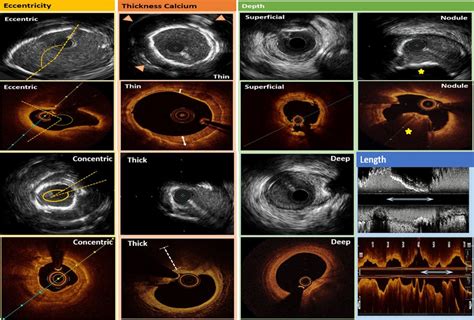 Intravascular Ultrasound Rows 1 And 3 And Optical Coherence Download Scientific Diagram